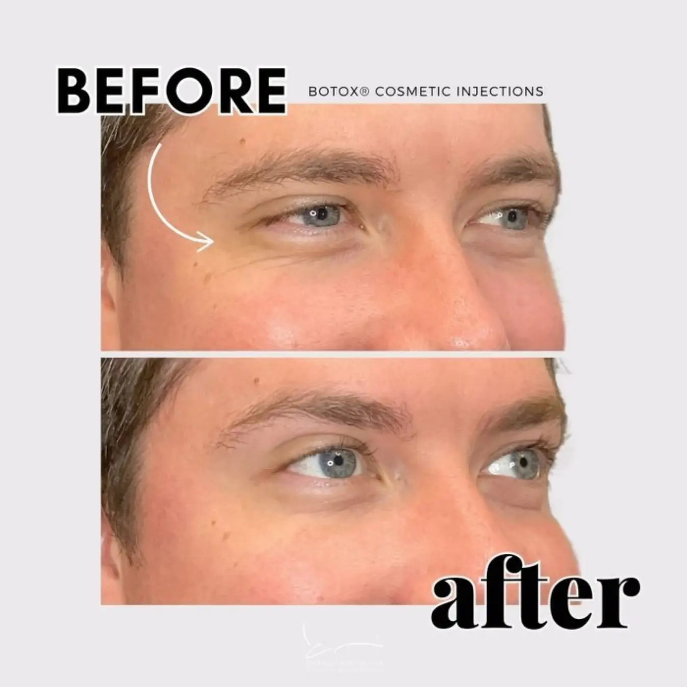 BOTOX for men