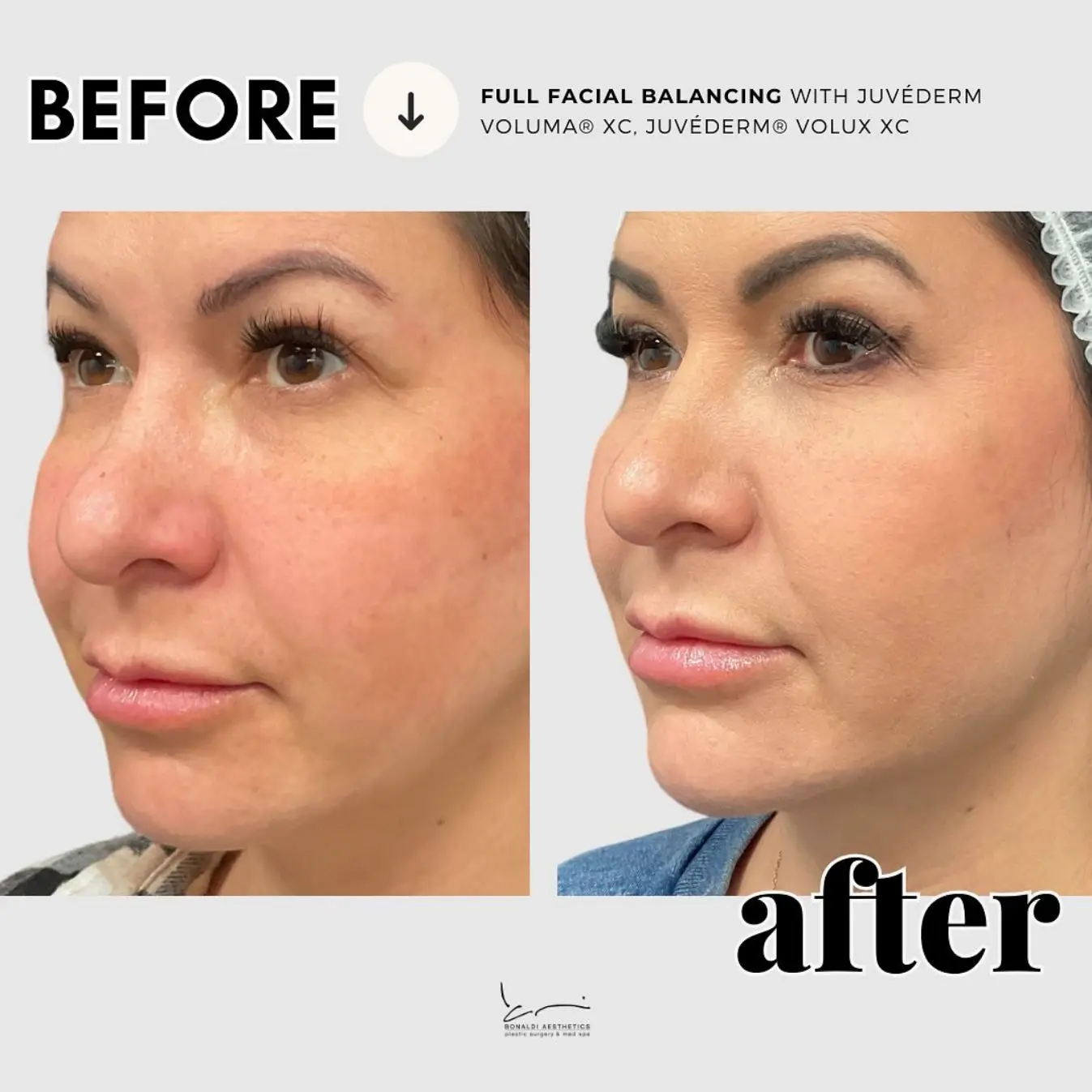 Before and After Juverderm