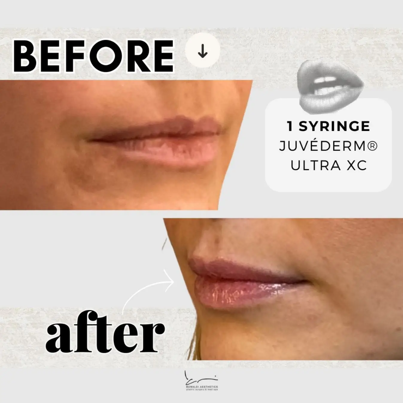 Before and After Juverderm lips