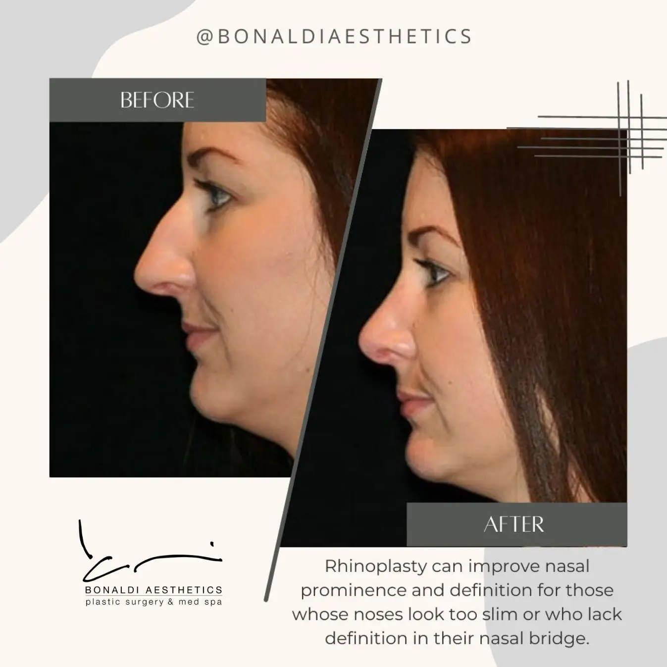 Before and after rhinoplasty