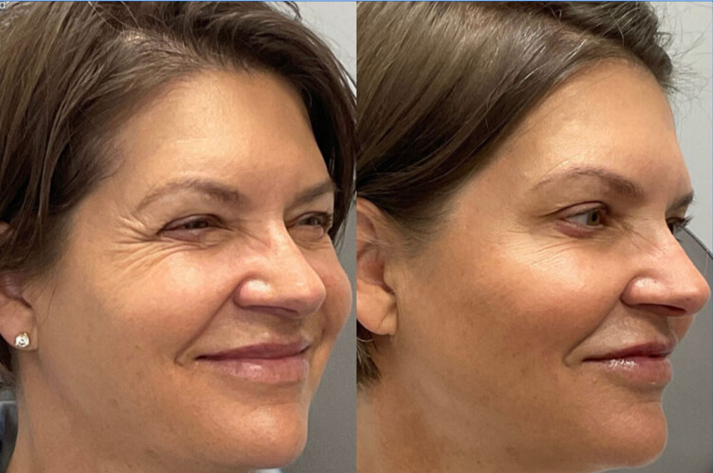 botox patient