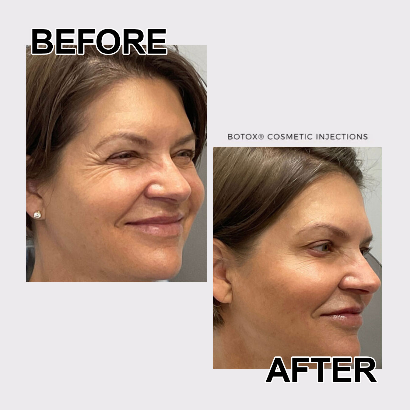 botox patient