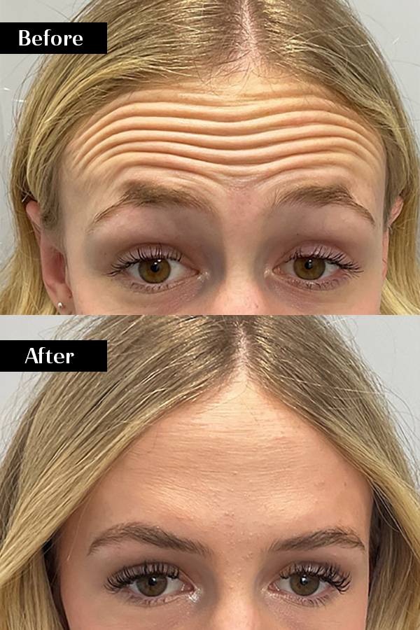 Before and after injectable results