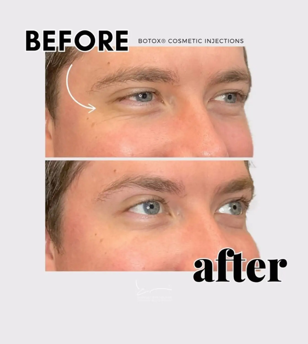 Botox before and after patient results