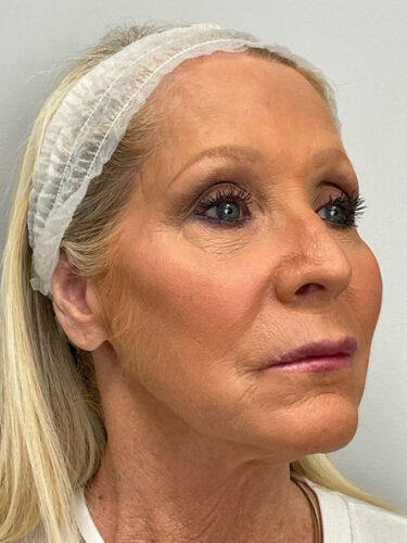 Injectables After Patient 15