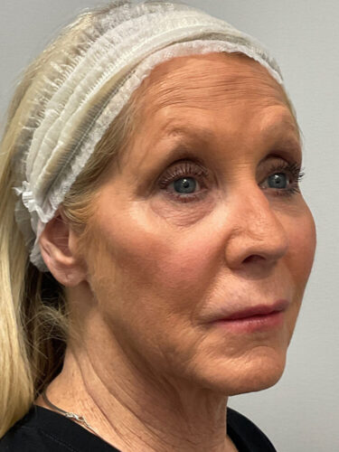 Injectables Before Patient 15