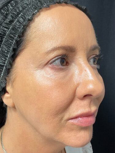 Injectables Before Patient 16