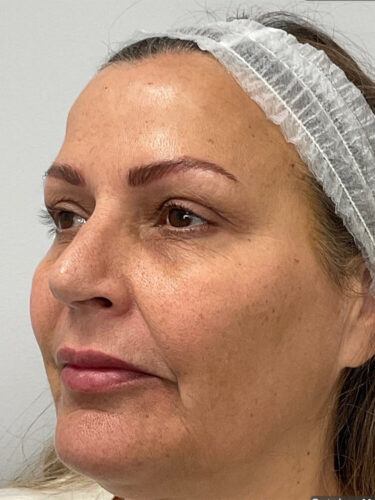 After Full Face Filler & BOTOX® Cosmetic