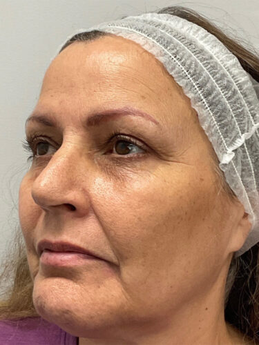 Before Full Face Filler & BOTOX® Cosmetic