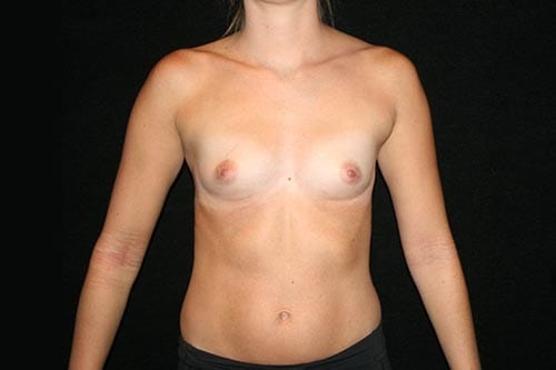 Before Breast Augmentation Surgery