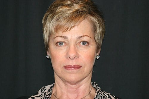 Before and After Facelift - Bonaldi Aesthetics Plastic Surgery & Med Spa