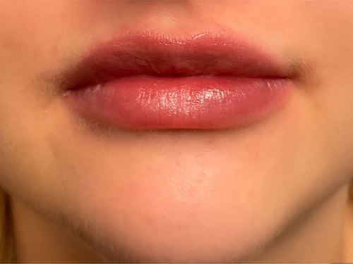 Injectables After Patient 8