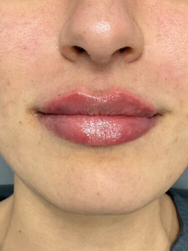 Injectables After Patient 11