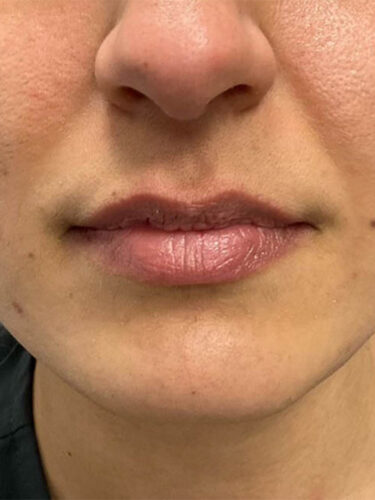 Injectables Before Patient 11